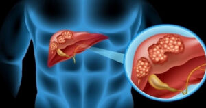 Colangiocarcinoma: cos’è, sintomi, cause e cure del tumore dei dotti biliari