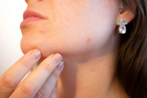 Hai provato di tutto contro l’acne? Forse stai ignorando questi fattori